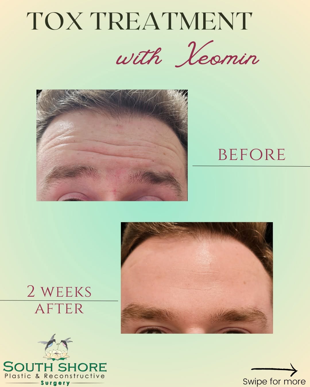 Instagram post by Dr. Jonathan Landon: Before ➡️ After: Subtle, Smooth, and Seriously Impressive 💪 Check out this transformation! Our patient was treated with Xeomin by @jordanth…
