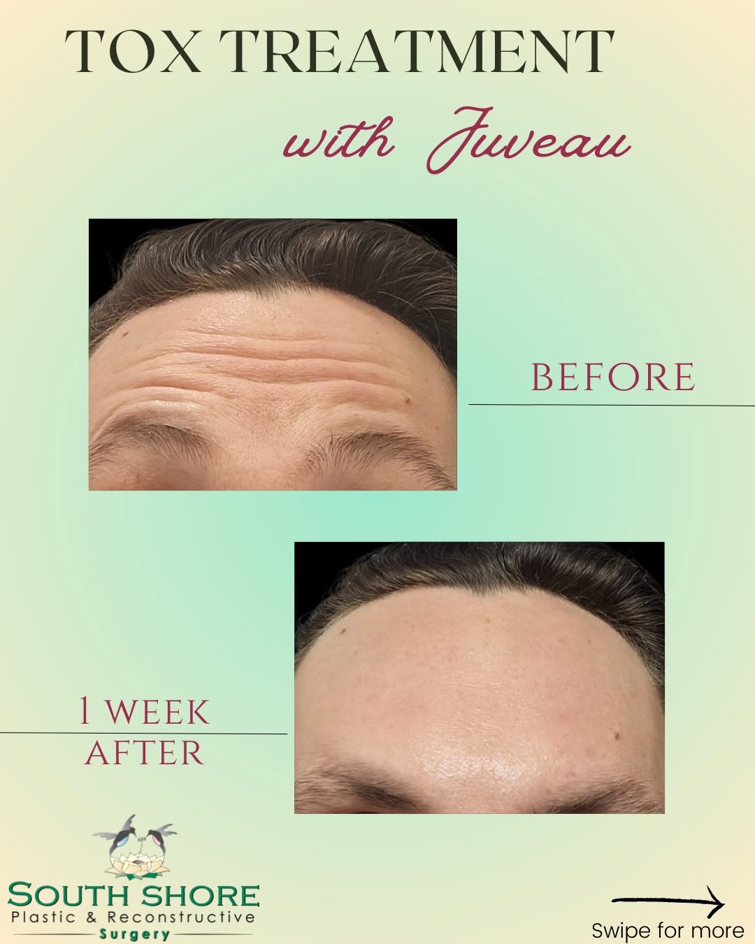 Instagram post by Dr. Jonathan Landon: **From tired to timeless 💥** Swipe to see the difference Jeuveau can make! 👏 @jordantheplasticspa was treated with Jeuveau (aka *Newtox*) …