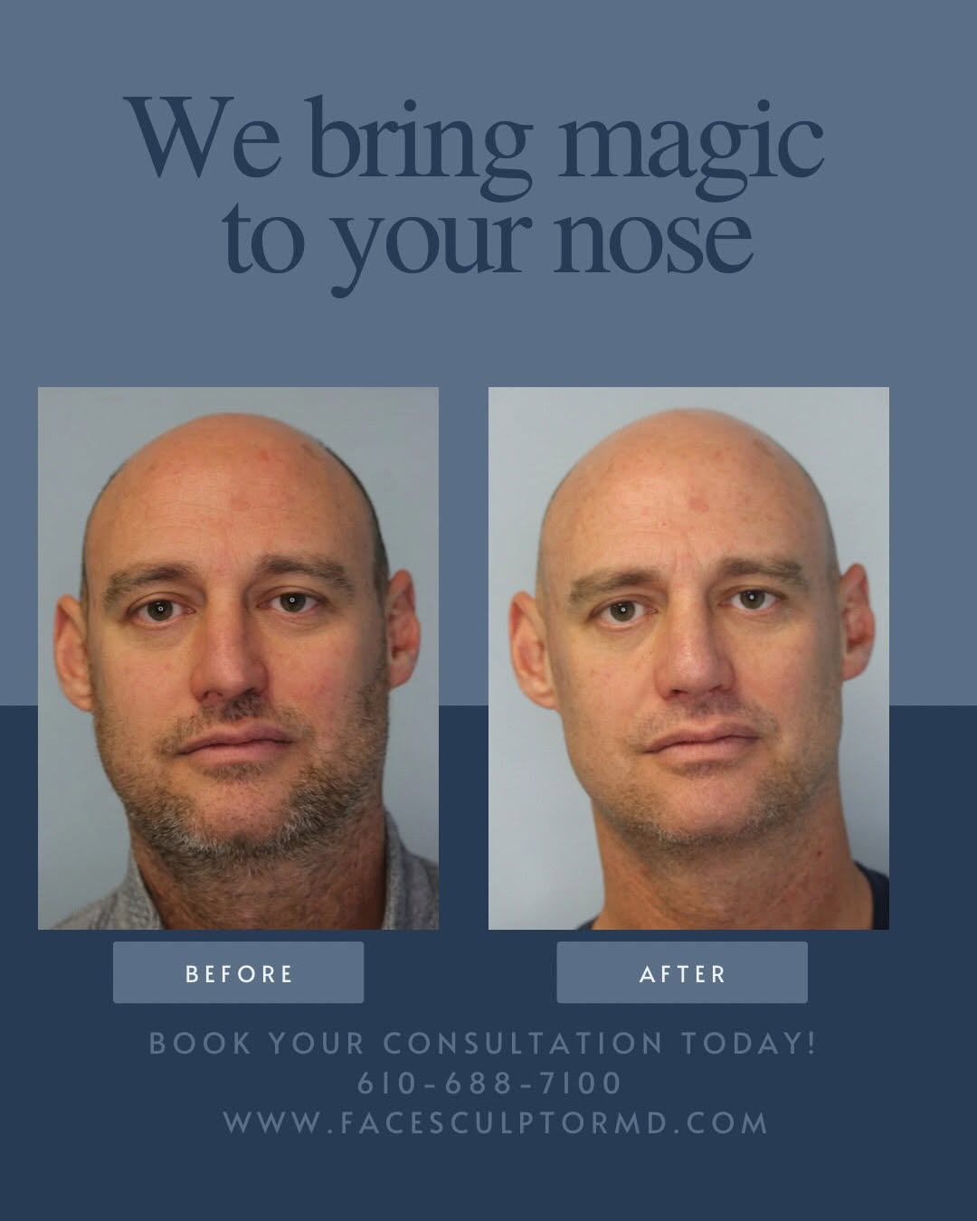 Instagram post by Dr. Jonathan Pontell: Take a look at one of Dr. Weng’s rhinoplasty patients. The transformation is magical. Especially, in the second photo! How can we help you? …