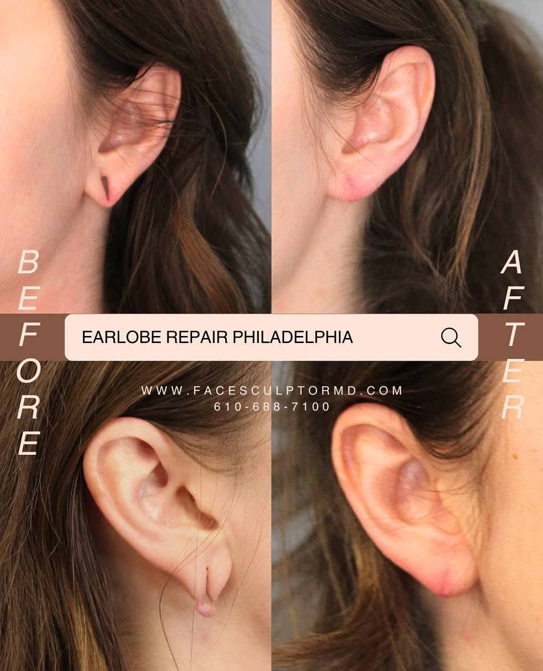 Instagram post by Dr. Jonathan Pontell: Did you have gauge earrings in the past and want them reversed now? If so, Dr. Pontell or Dr. Weng can help you. See here for one of Dr. Wen…