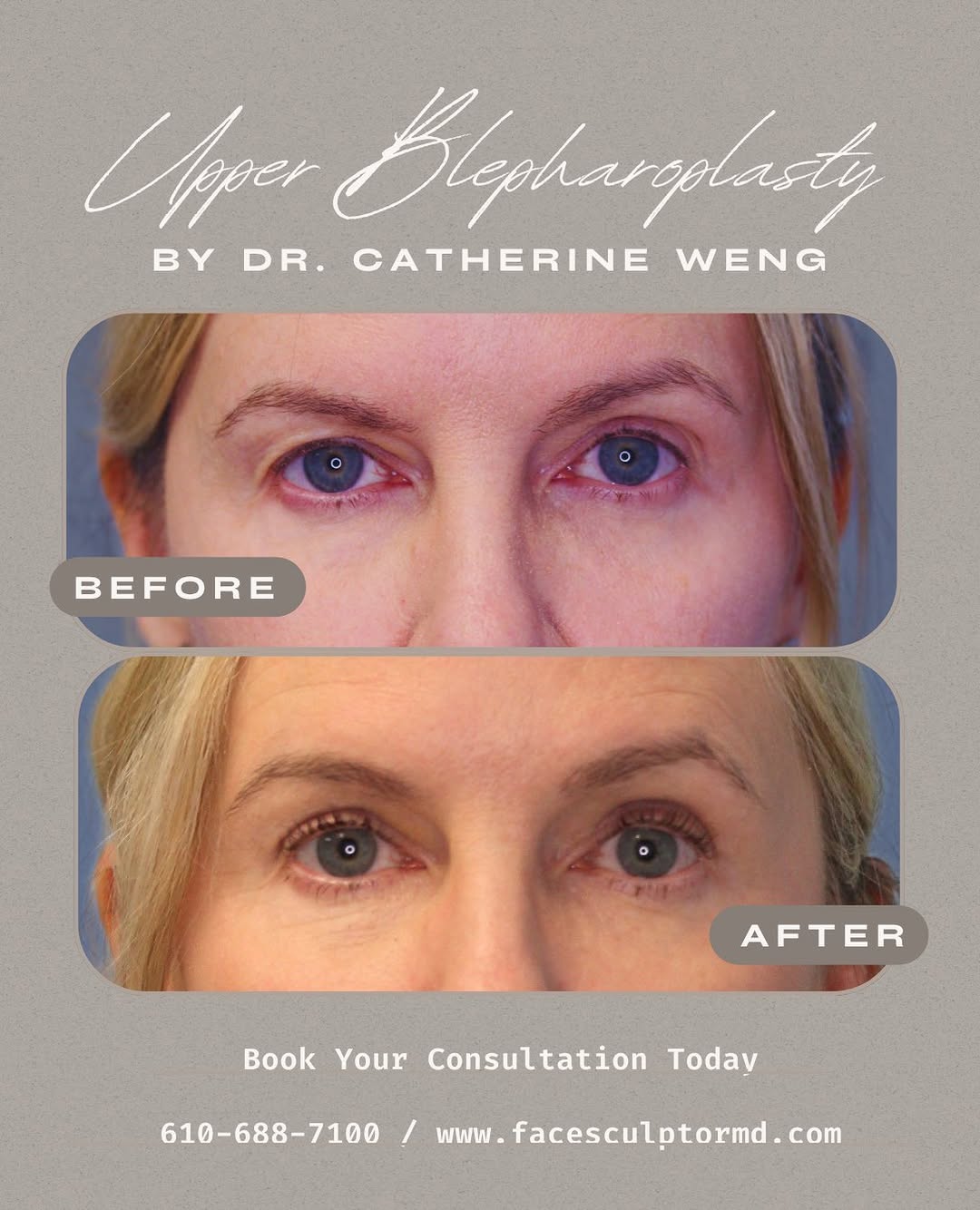 Instagram post by Dr. Jonathan Pontell: Do your eyes look tired? Do your eyes feel heavy? Do people ask if you are tired? Well if your answer is yes to any of these questions, our …