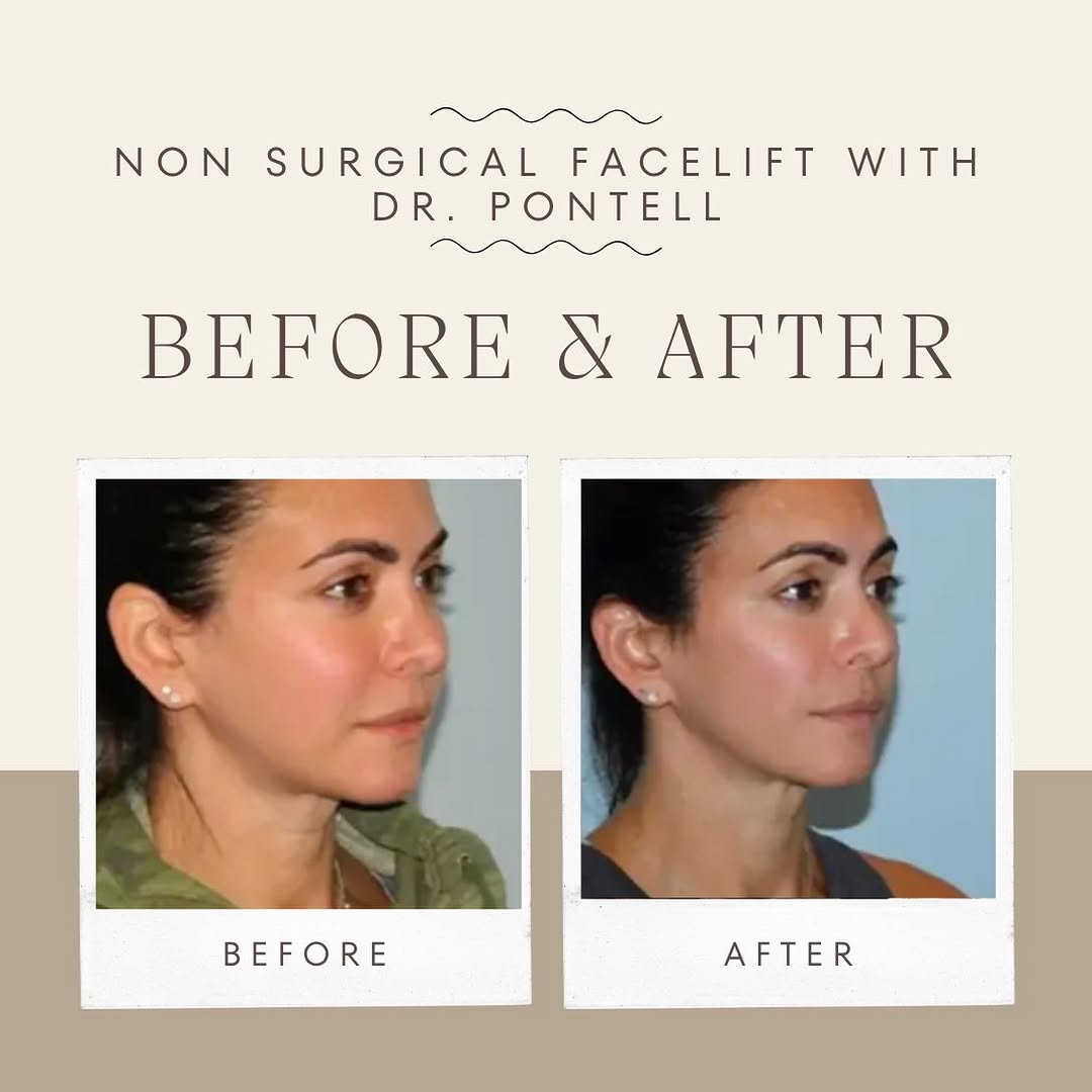 Instagram post by Dr. Jonathan Pontell: Do you have minor concerns on your neck and/or jowl area? Do you want to upkeep your facelift from the past? Ultherapy (non surgical facelif…