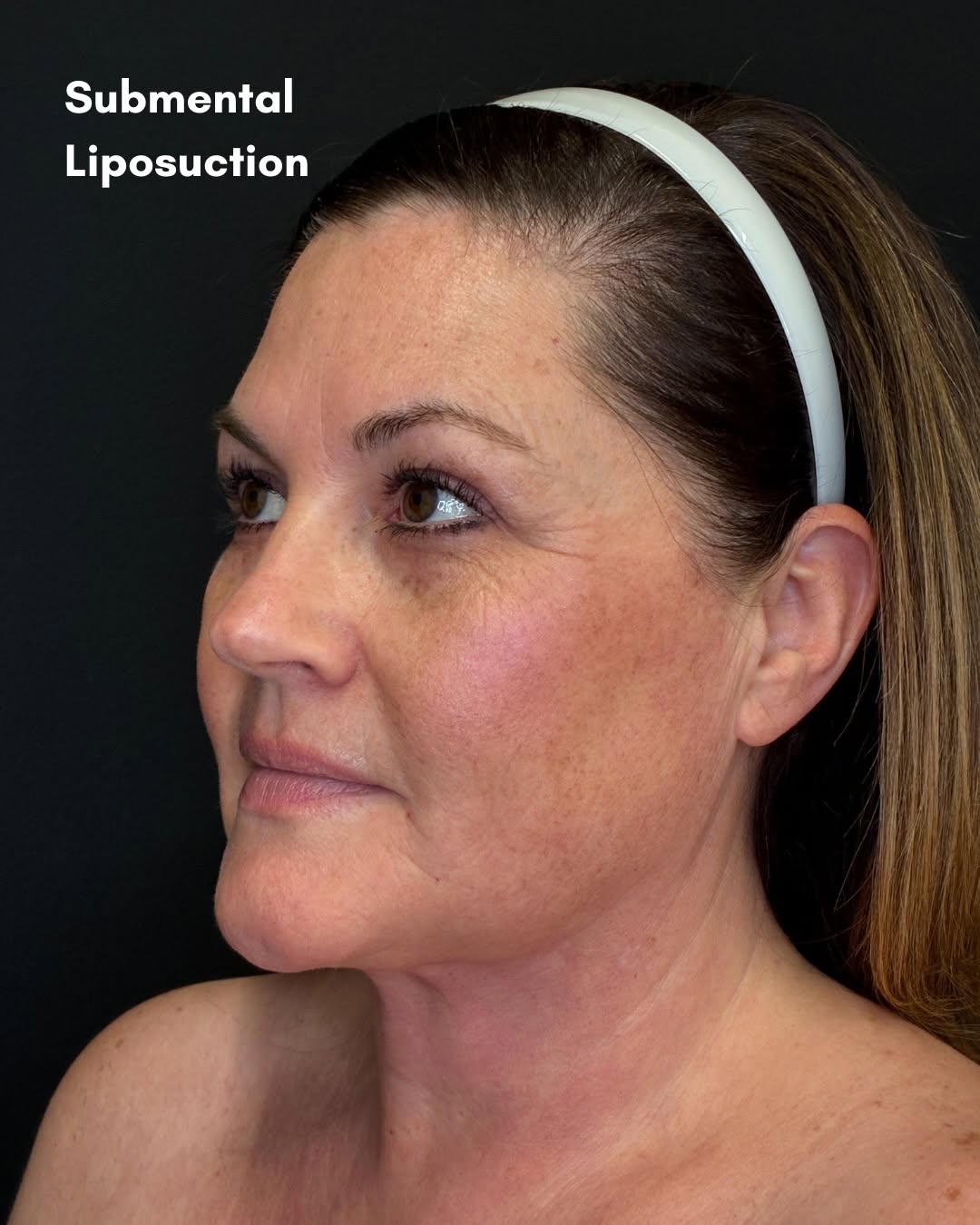 Instagram post by Dr. Jonathan R. Freed: Looking younger and refreshed with some submental lipo💛 This before and after of submental liposuction by Dr. Freed shows how a subtle chan…
