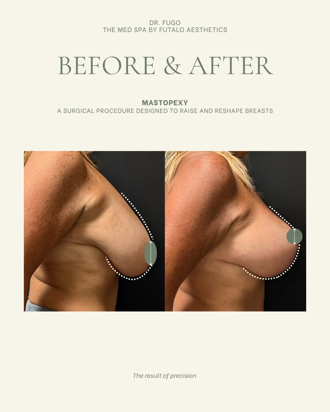 Instagram post by Dr. Jonathan R. Fugo: A breast lift is one of the most transformative procedures I perform because it restores what was always there. Excess skin removed, tissue …
