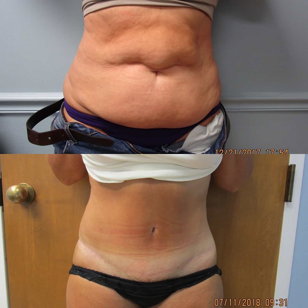 Instagram post by Dr. Jonathan Saunders: Abdominoplasty with liposuction of bilateral flanks
