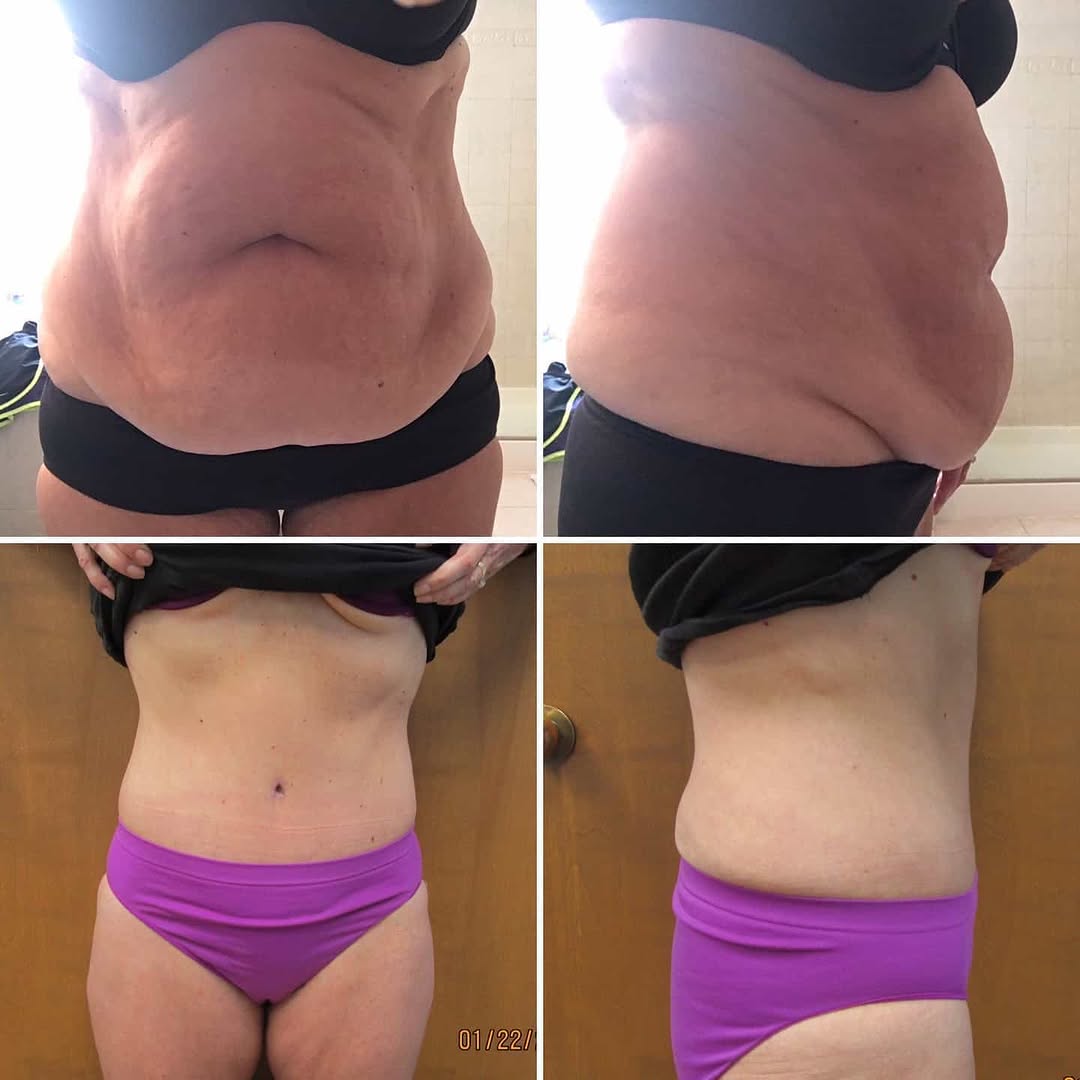 Instagram post by Dr. Jonathan Saunders: Abdominoplasty with liposuction of bilateral flanks
