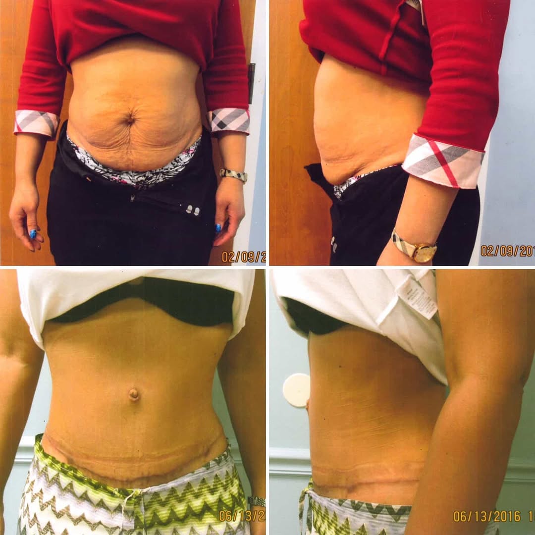 Instagram post by Dr. Jonathan Saunders: Cutaneous (no muscle tightening) Abdominoplasty with liposuction of bilateral flanks