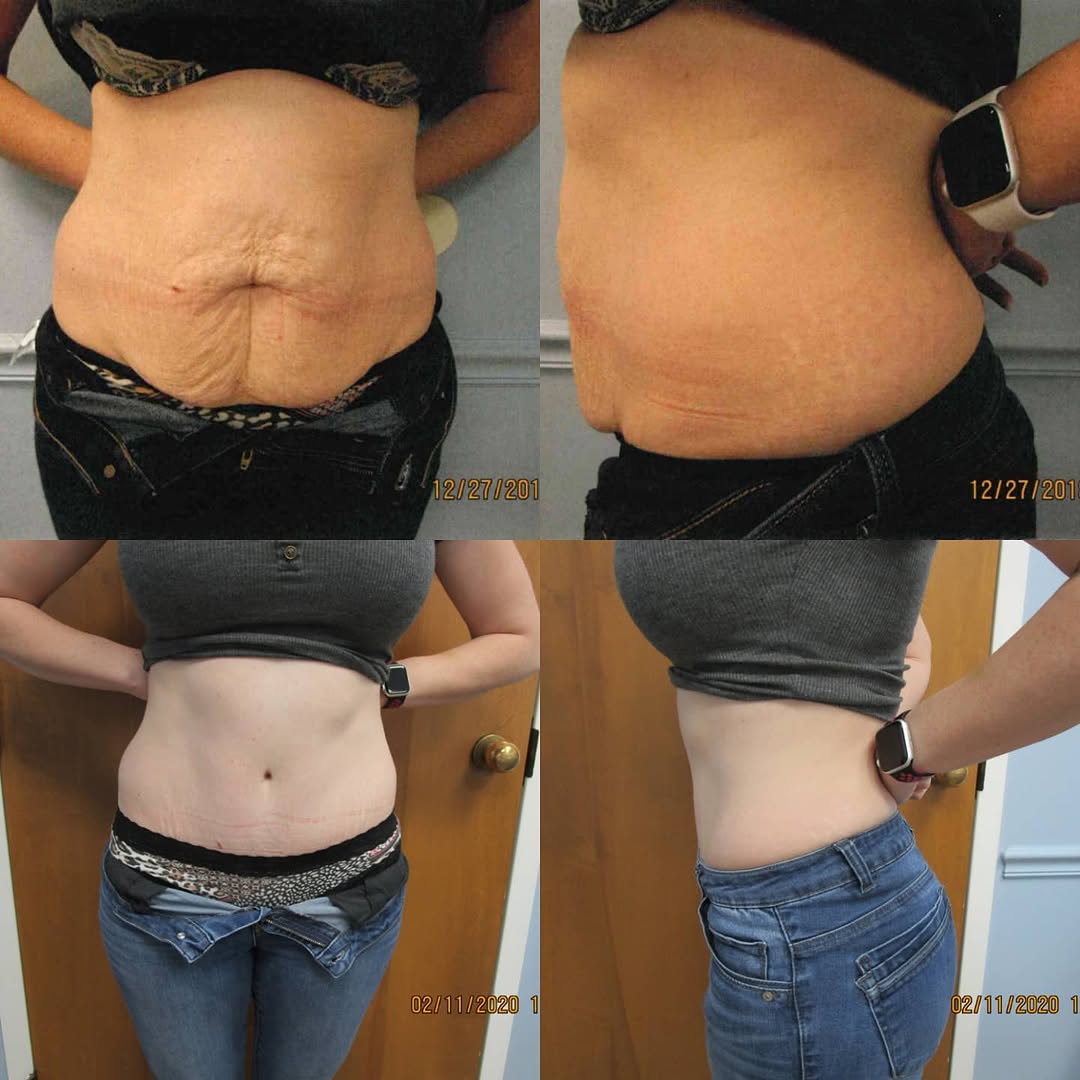 Instagram post by Dr. Jonathan Saunders: Cutaneous Abdominoplasty with liposuction