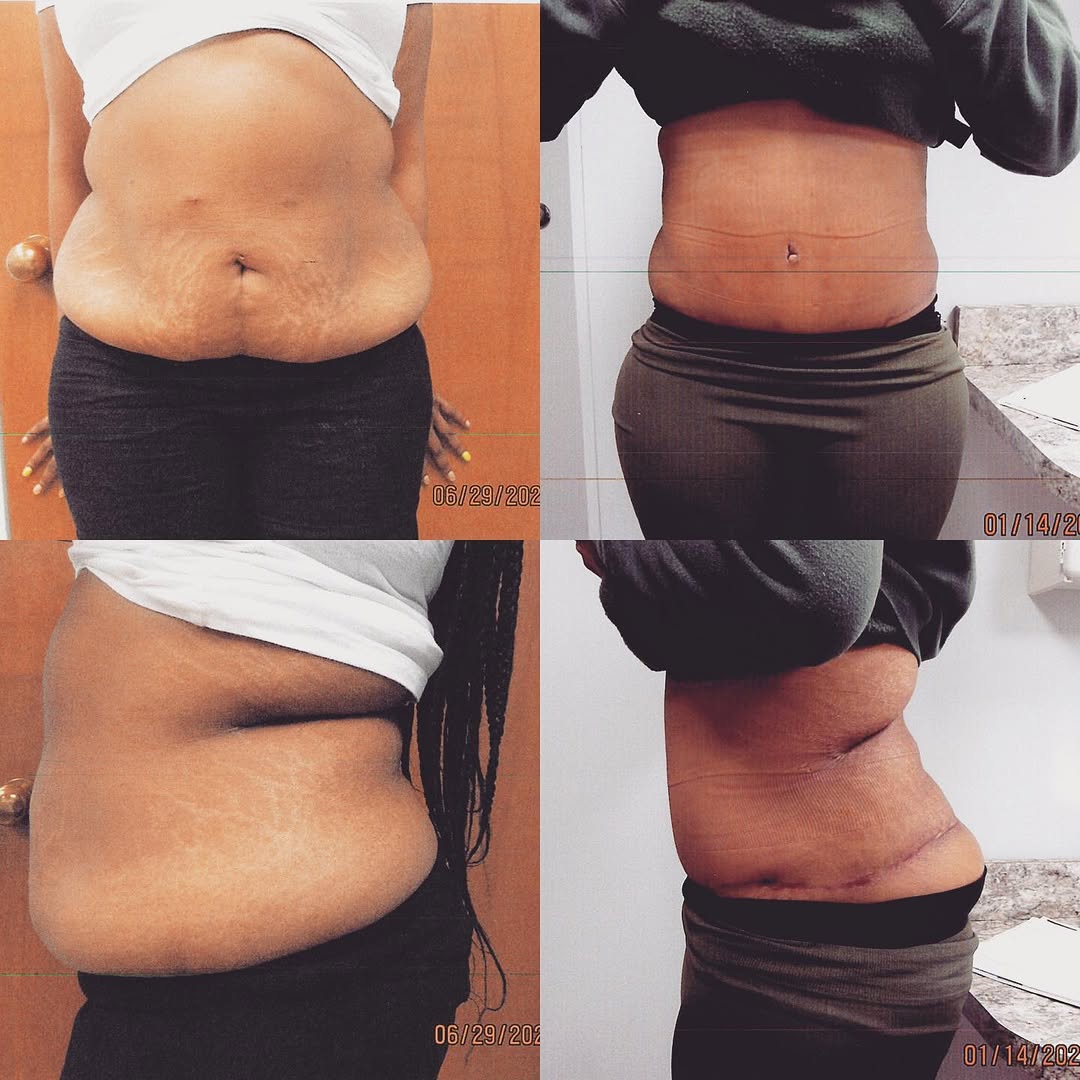 Instagram post by Dr. Jonathan Saunders: ~Abdominoplasty with liposuction of bilateral flanks~ Get ready for summer! Call our office at 302-368-9611 for your free consultation.