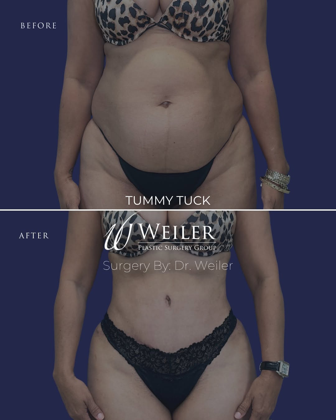 Instagram post by Dr. Jonathan Weiler: Tummy Tuck Before and After By Dr. Weiler 🥼 #WeilerPlasticSurgery #TummyTuck #BoardCertifiedPlasticSurgeon #LIPO