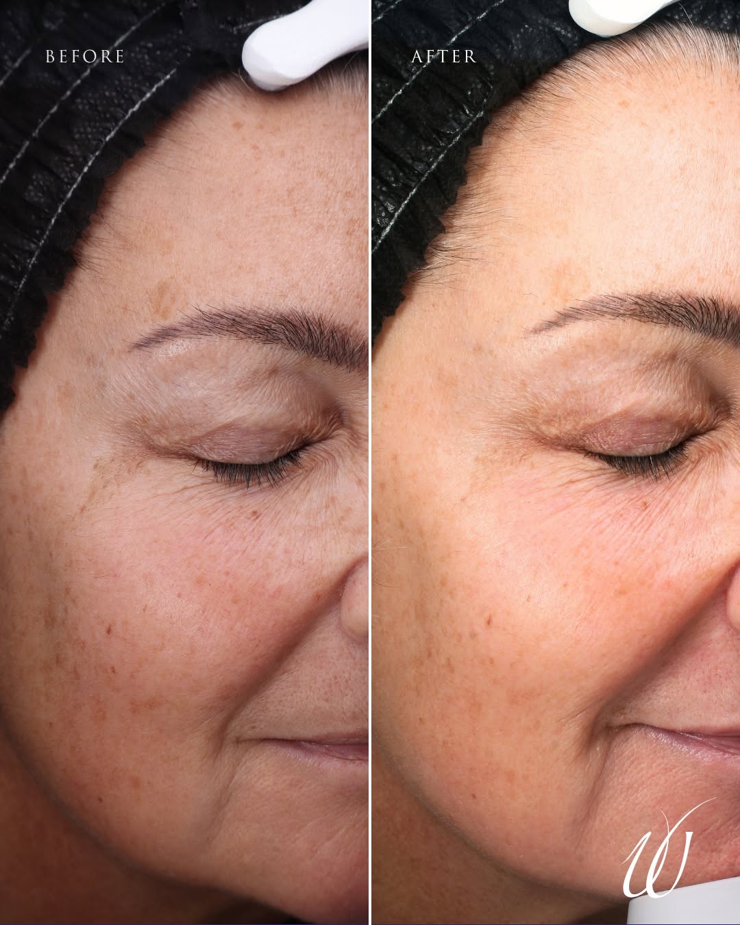 Instagram post by Dr. Jonathan Weiler: The power of a microneedling series 💫 After a full microneedling series, this patient has less sun spots, brighter skin tone, and a clearer…