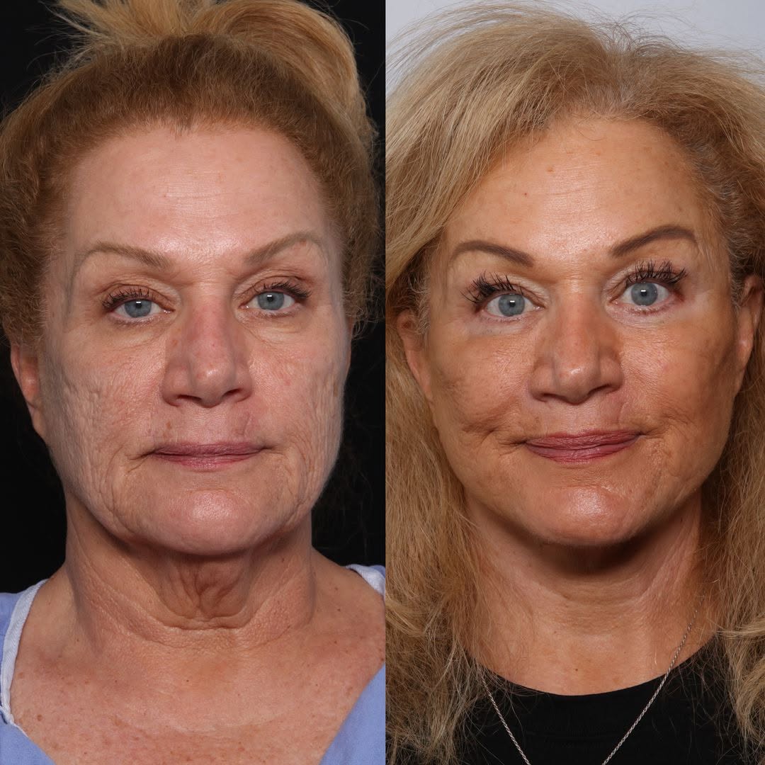 Instagram post by Dr. Jonathan Zelken: Our patient, a 68-year-old woman, is shown 3 months after a demanding face and neck lift. Achieving this degree of refinement required a com…
