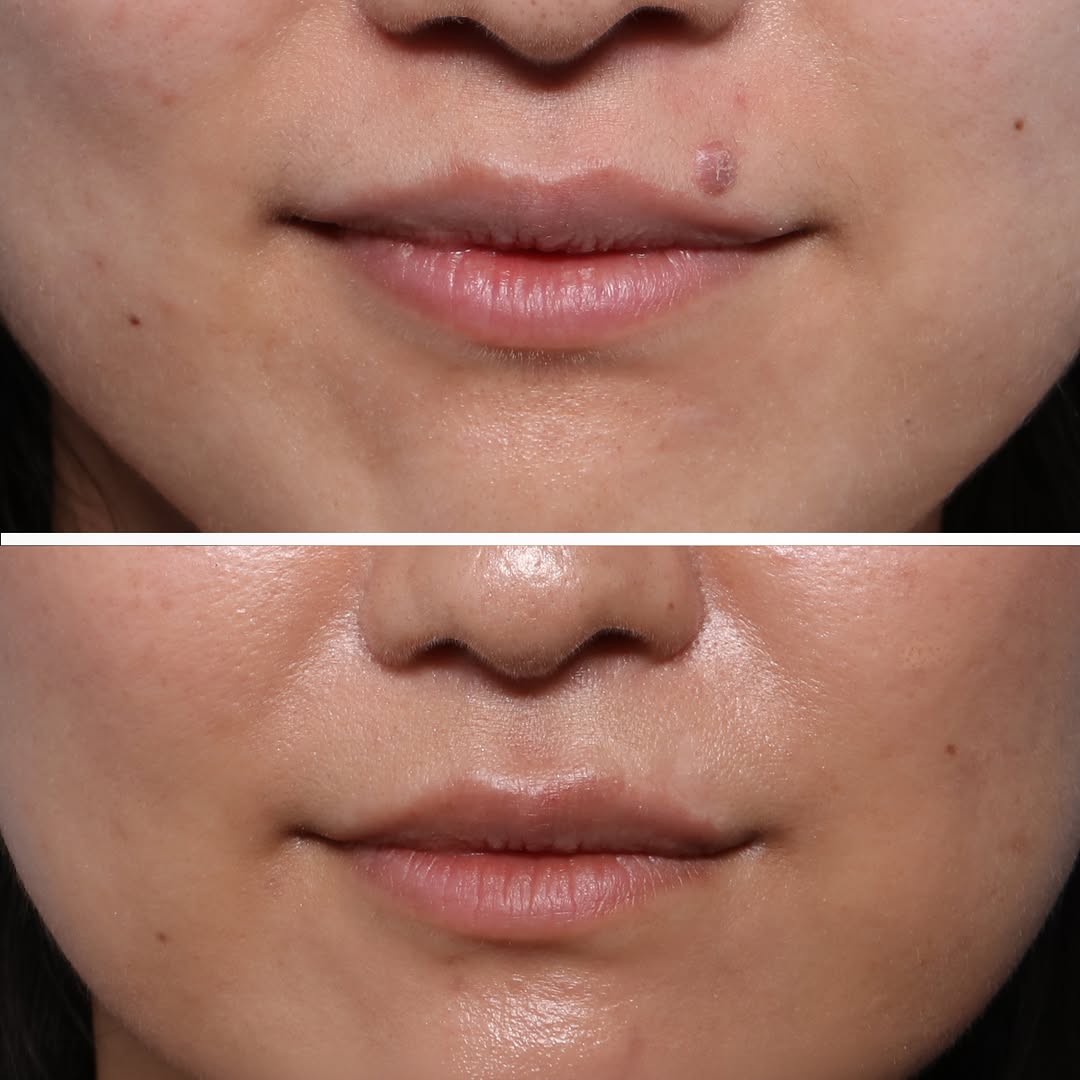 Instagram post by Dr. Jonathan Zelken: Sometimes a small change can make a significant difference, especially when something has bothered a patient for years. This patient had a m…
