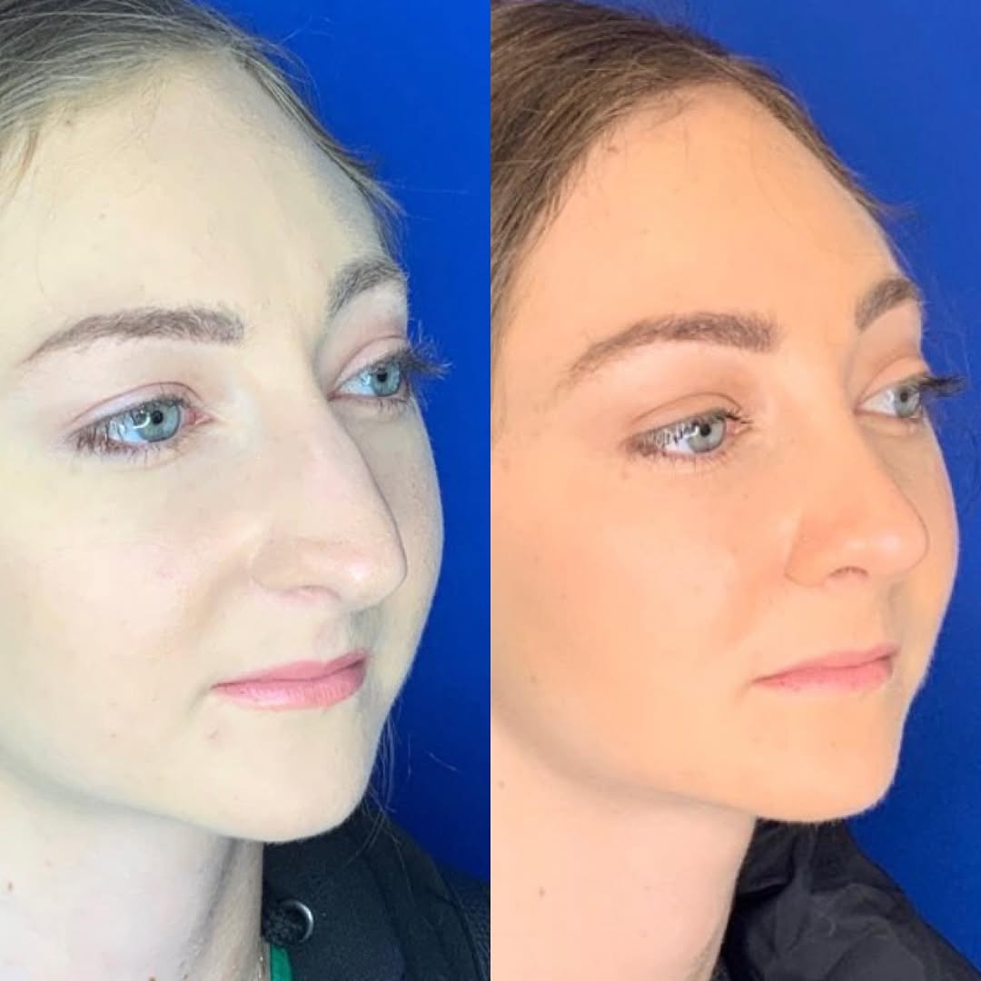 Instagram post by Dr. Jonnae Ostrom: This gorgeous patient is 2 months out from her combination functional and cosmetic nasal surgery. ❤️ I love how in her “after” photos her ey…