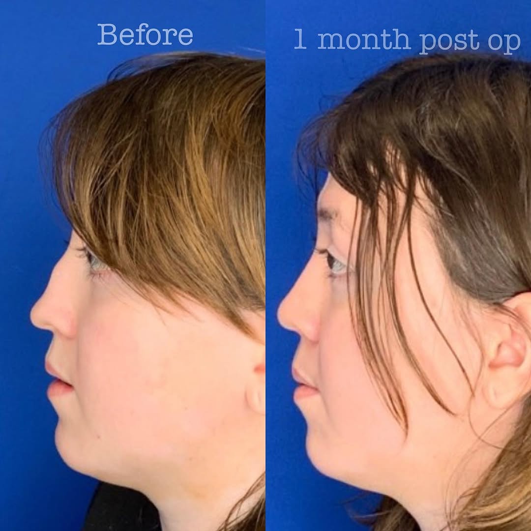 Instagram post by Dr. Jonnae Ostrom: Saddle nose deformity. This occurs for several reasons. Sometimes from prior trauma to the nose, sometimes from aggressive prior surgery, so…