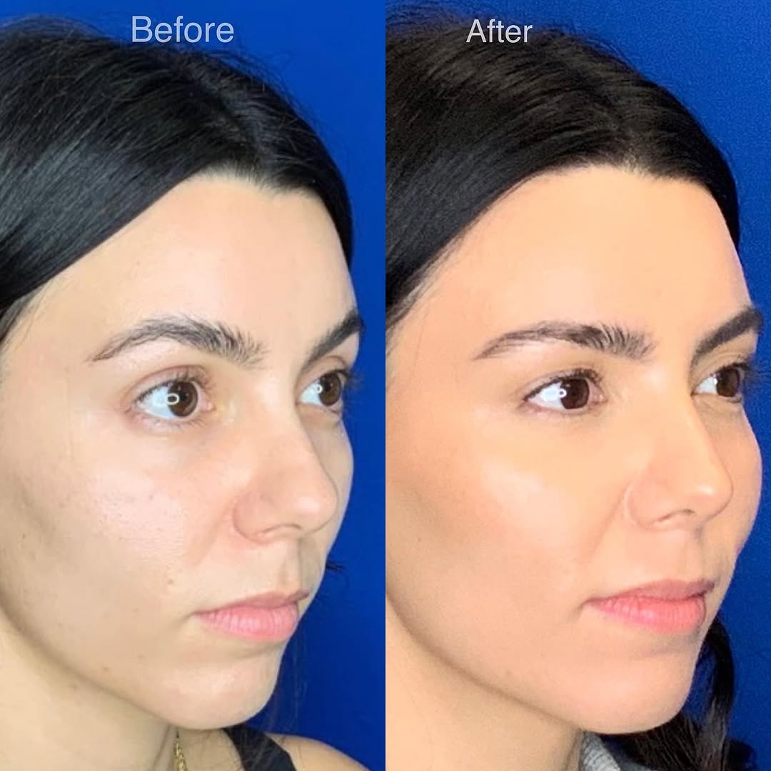Instagram post by Dr. Jonnae Ostrom: Tip rhinoplasty or changing the shape of the nasal tip, is a powerful way to alter proportions in the middle of the face. As you can see in …