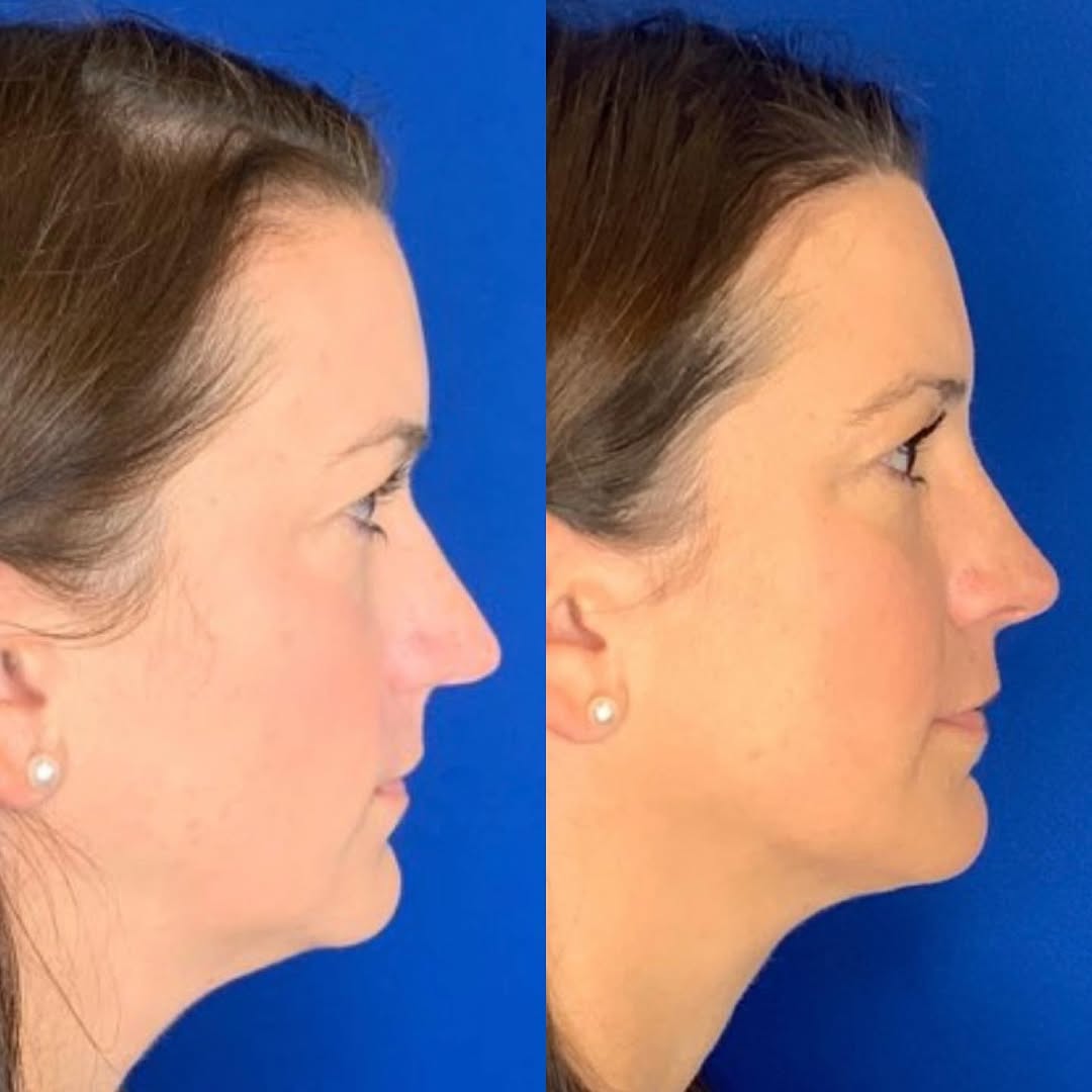Instagram post by Dr. Jonnae Ostrom: Subtle changes to the nose for this beauty giving her an overall smaller and less conspicuous nose. She really did not like her bifid nasal …