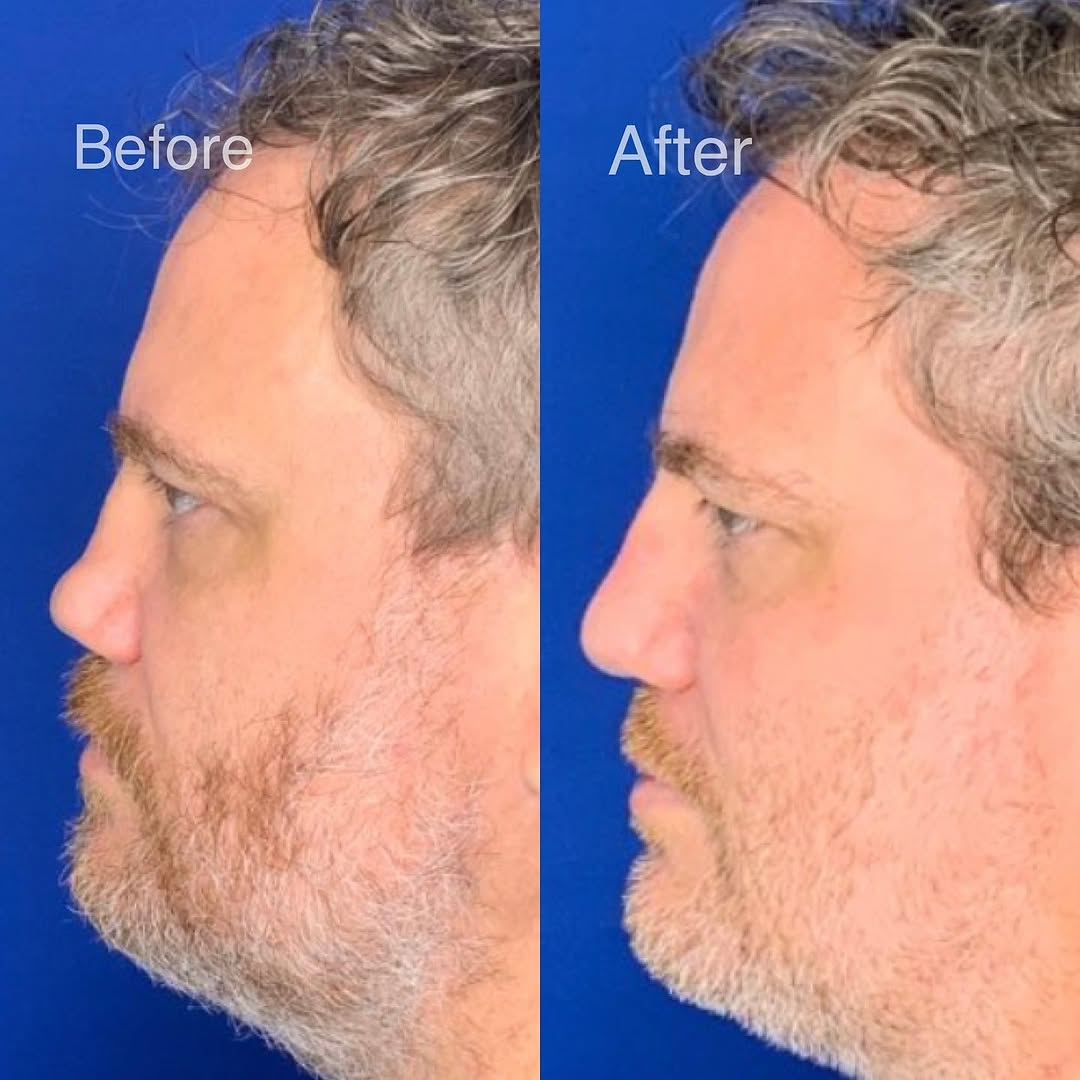 Instagram post by Dr. Jonnae Ostrom: Another example of how repairing a severely saddled nose can improve not only form but function. This gentleman can now breath easily throug…