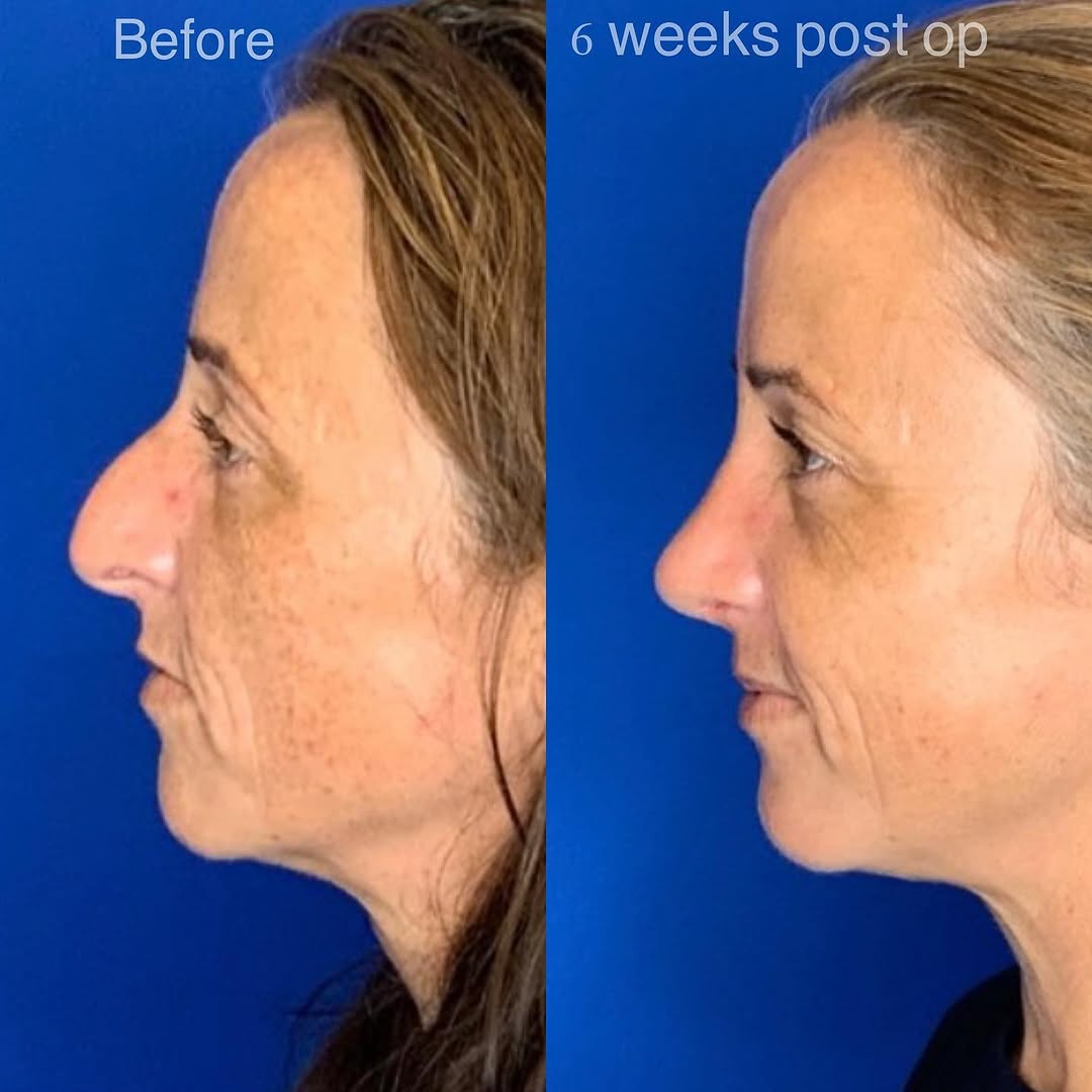 Instagram post by Dr. Jonnae Ostrom: When a rhinoplasty changes not only your profile, but the way you feel! We are loving this beautiful and spunky patient’s transformation! 👃…