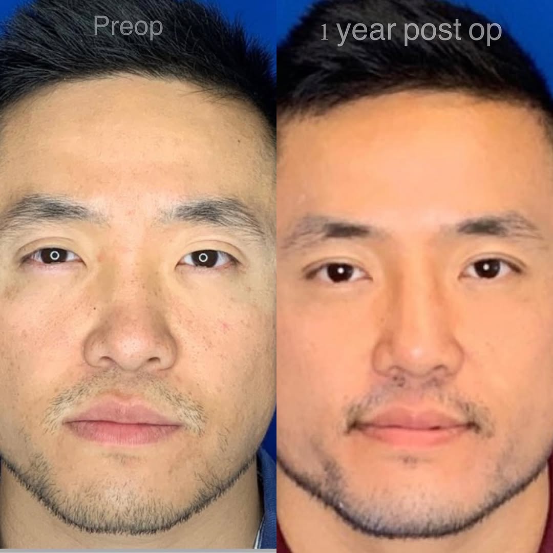 Instagram post by Dr. Jonnae Ostrom: Augmentation rhinoplasty. This man wanted more from his profile and a rib cartilage graft was just what he needed! Here he is one year post …
