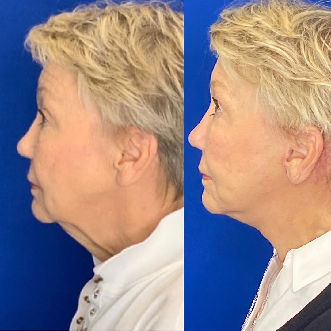 Instagram post by Dr. Jonnae Ostrom: This fantastic woman just wanted to be rid of the excess skin on her neck. She wanted a natural result that didn’t look “done”. I think we h…