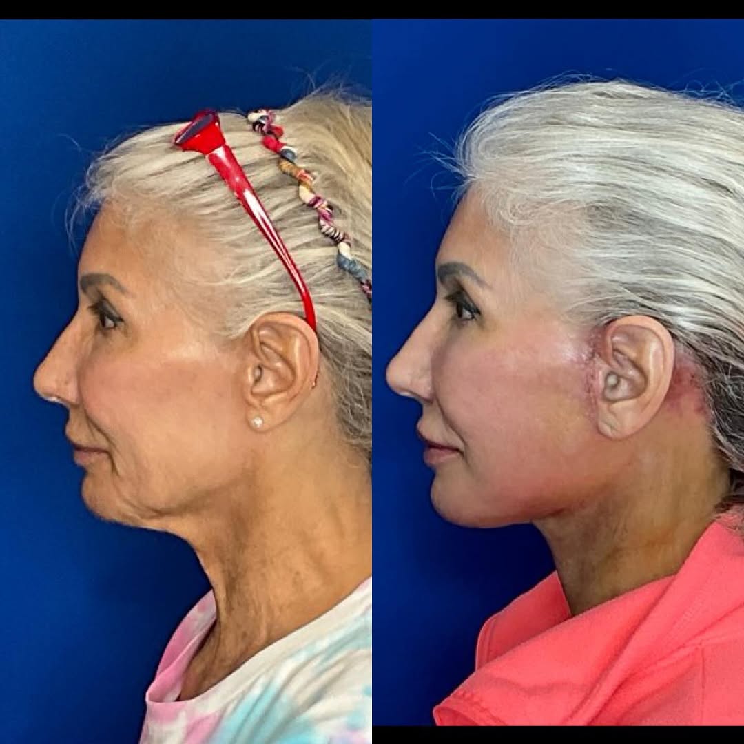 Instagram post by Dr. Jonnae Ostrom: Early results from a recent face and neck lift! We are loving her refreshed neck! She is just 1 week out and had her sutures removed today.