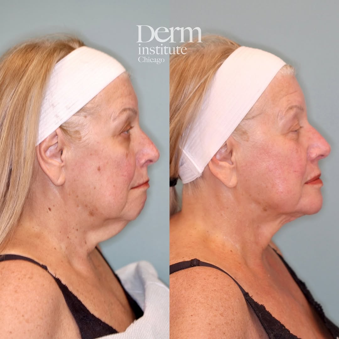 Instagram post by Dr. Jordan C. Carqueville: Who needs a gobble turkey neck!? No thank you! On the menu today is a home-run cosmetic outcome using a minimally invasive approach. These r…