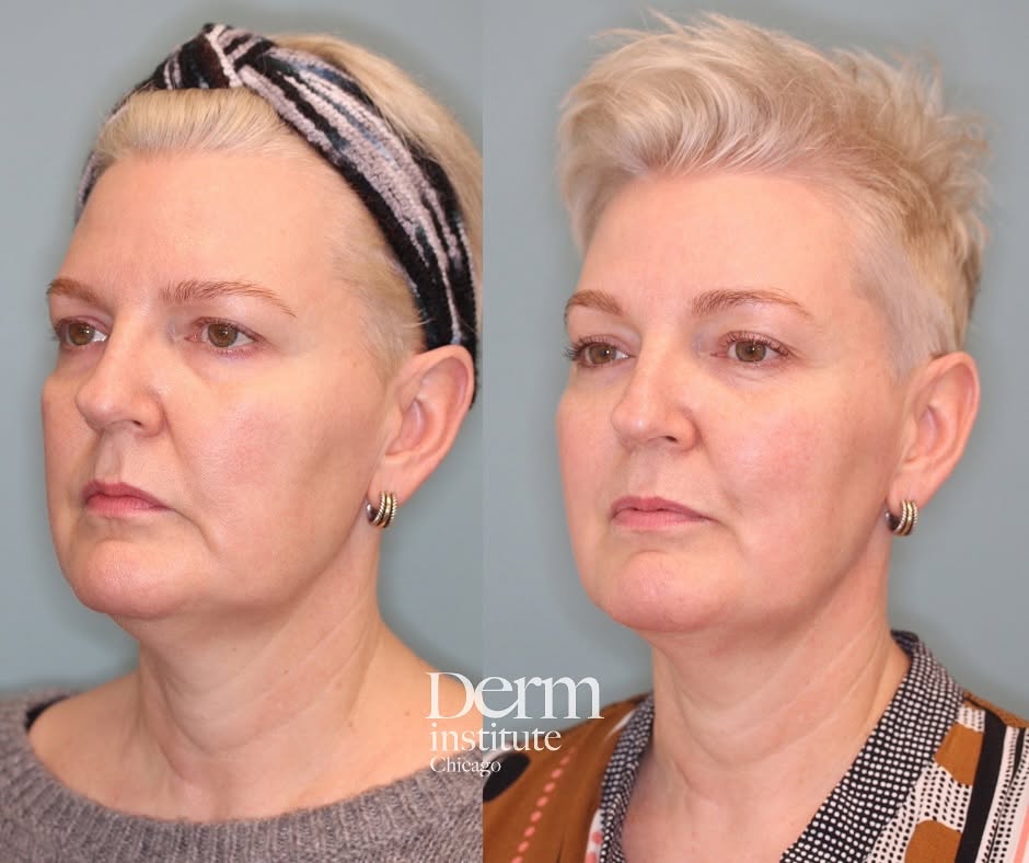Instagram post by Dr. Jordan C. Carqueville: I love this photo and love LOVE this person! This #beforeandafter demonstrates the effects of minimally invasive techniques applying bipolar…