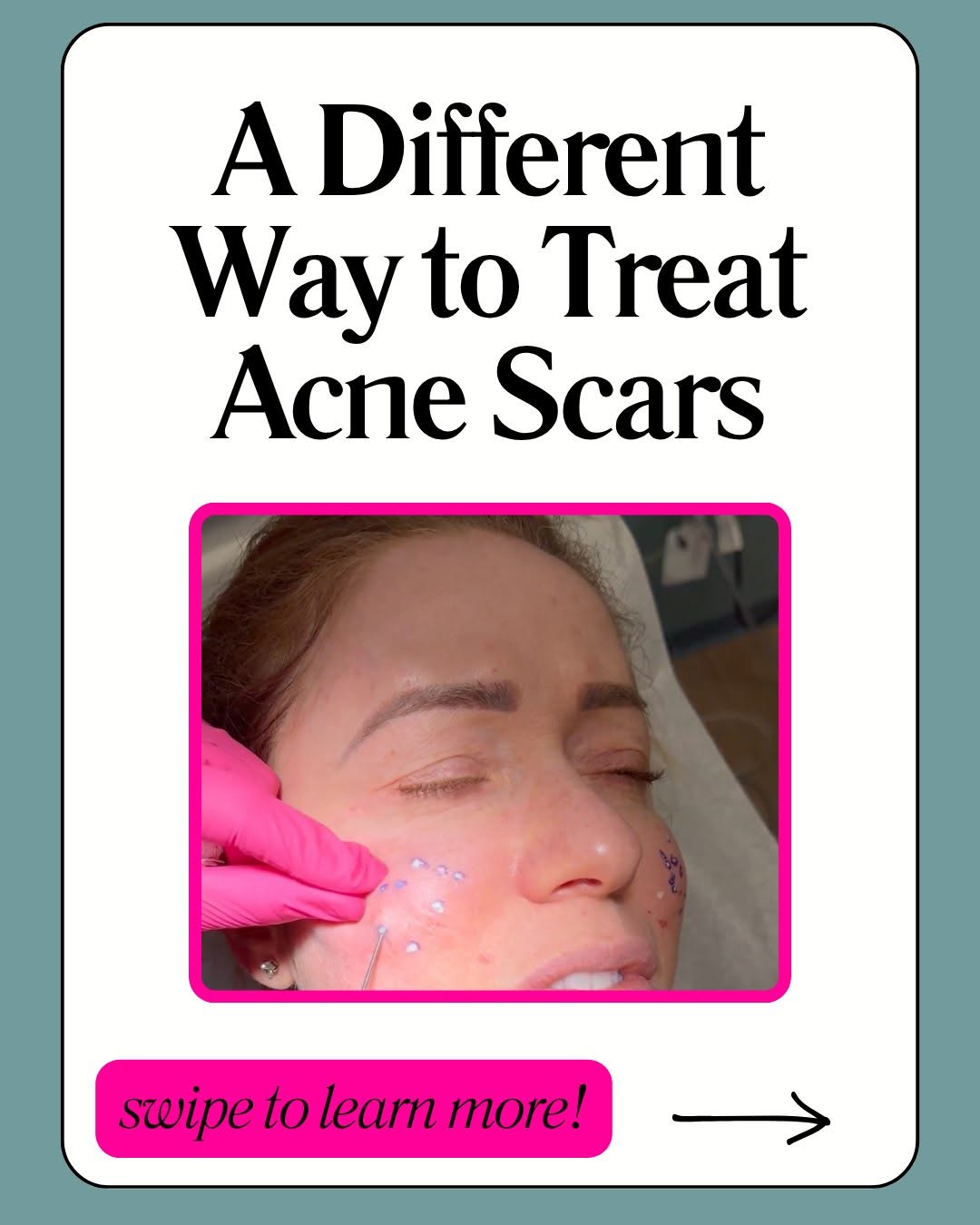 Instagram post by Dr. Jordan C. Carqueville: Some acne scars aren't just on the surface — they're tethered beneath the skin. That's where subcision comes in. By releasing these fibrous …