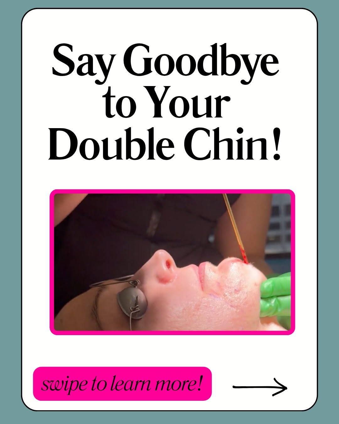 Instagram post by Dr. Jordan C. Carqueville: That little pocket of fat under your chin doesn't have to be permanent. Submental liposuction is a targeted procedure that removes stubborn …