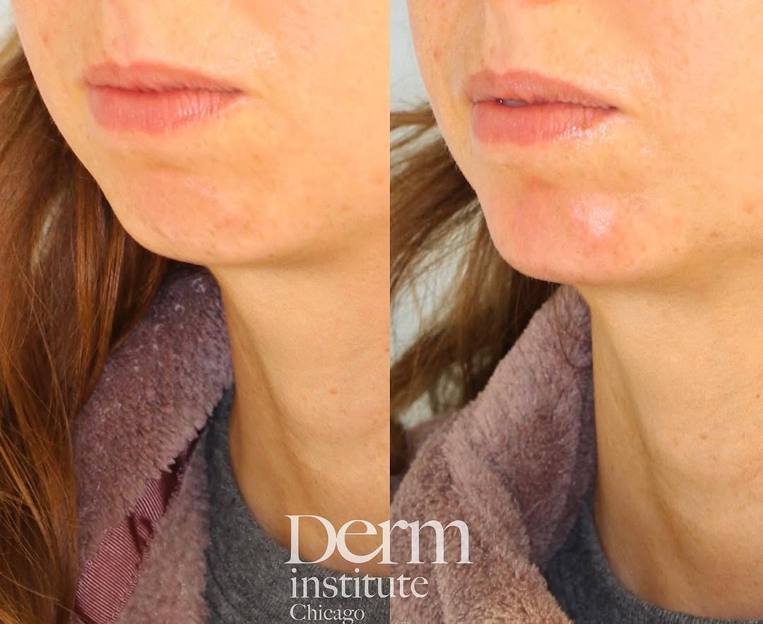 Instagram post by Dr. Jordan C. Carqueville: Chin augmentation with injectables is a safe and minimally invasive way to create that upside-down “triangle of youth.” Enhancing the chin a…