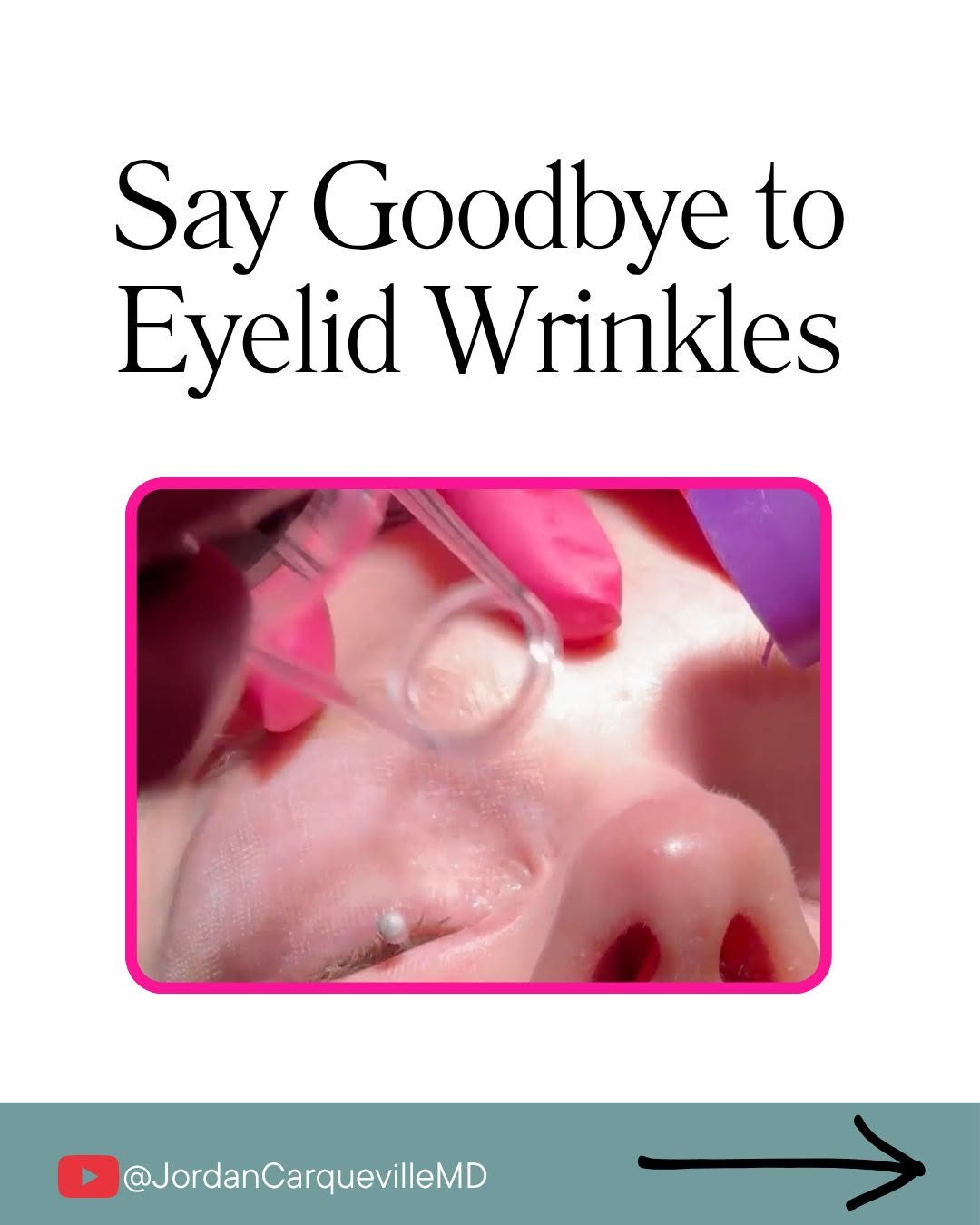 Instagram post by Dr. Jordan C. Carqueville: The skin around your eyes is one of the first places to show signs of aging — but advanced laser treatments can help. #antiaging #lasers #co…