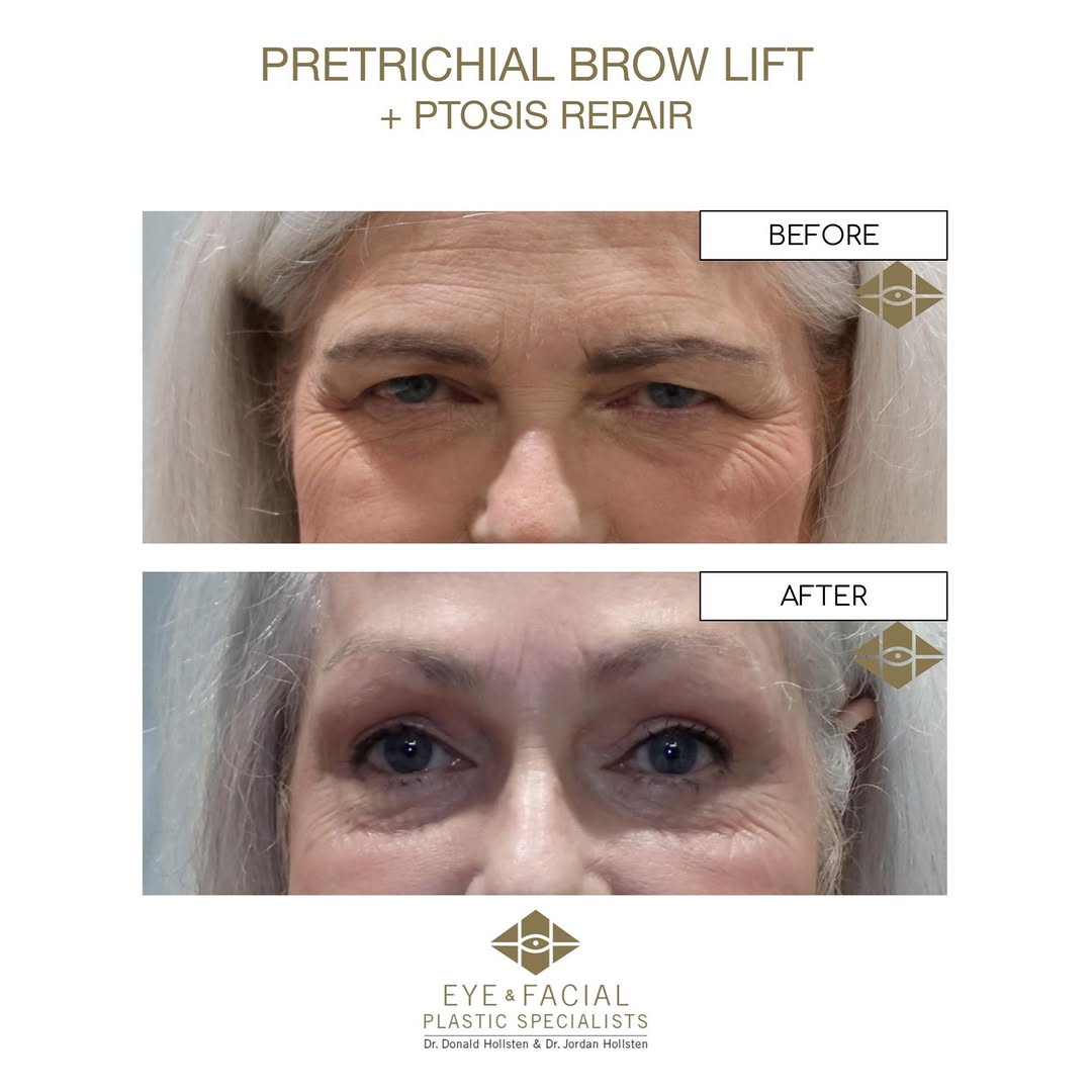 Instagram post by Dr. Jordan Hollsten: ✨Before and After ✨ . . . Pretrichial Browlift and Ptosis Repair! . . . #drjordanhollsten #eyeandfacialplasticspecialists #browlift #pretric…