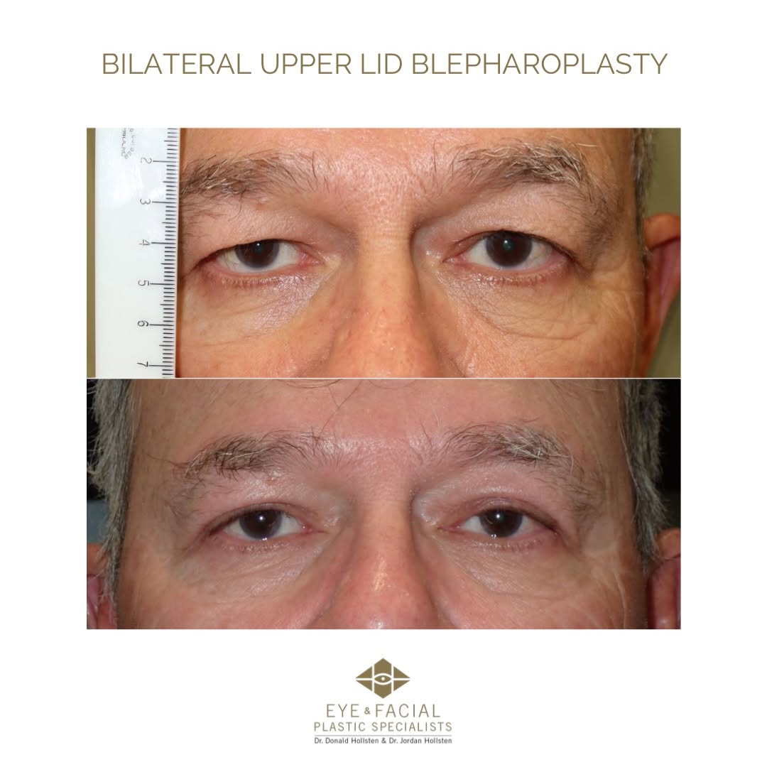 Instagram post by Dr. Jordan Hollsten: Bilateral Upper Lid Blepharoplasty Before and After ✨✨ #blepharoplasty #heavylids #drjordanhollsten