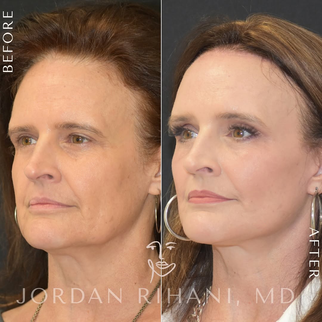 Before photo of female patient showing visible signs of aging including under-eye bags, volume loss in the cheeks, sagging along the jawline, and drooping brows.