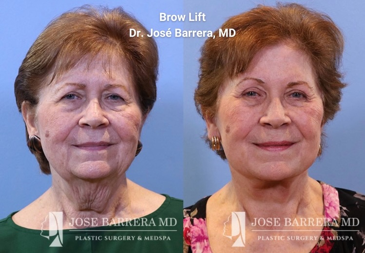 Instagram post by Dr. Jose Barrera: This patient is shown 1 month post-op s/p quad blepharoplasty, endoscopic brow lift, and L partial Submandibular gland excision. She couldn’…