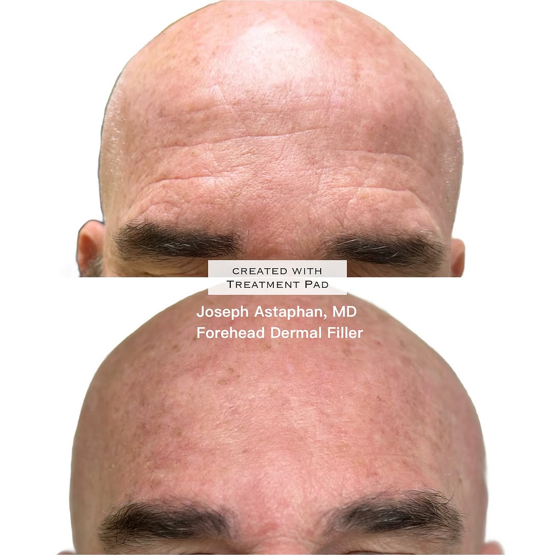 Instagram post by Dr. Joseph Astaphan: This patient’s eyebrows were too heavy to properly inject with a tox. He also did not like the loss of volume around his brows. Joseph Astap…