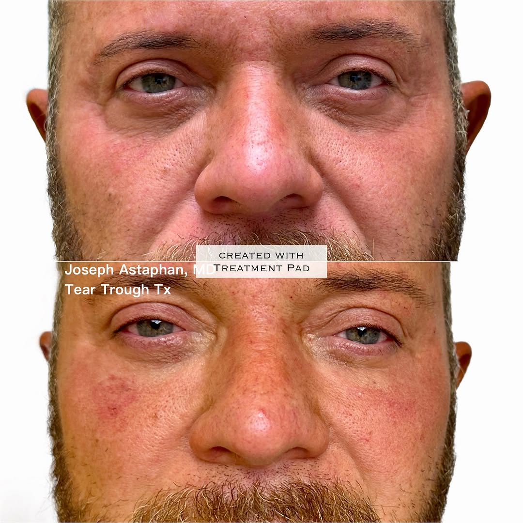 Instagram post by Dr. Joseph Astaphan: Tired of under eye hollows or dark circles? Find out if you are a candidate of the non-surgical treatment. Dr A, The Tear Trough Guru, is wo…