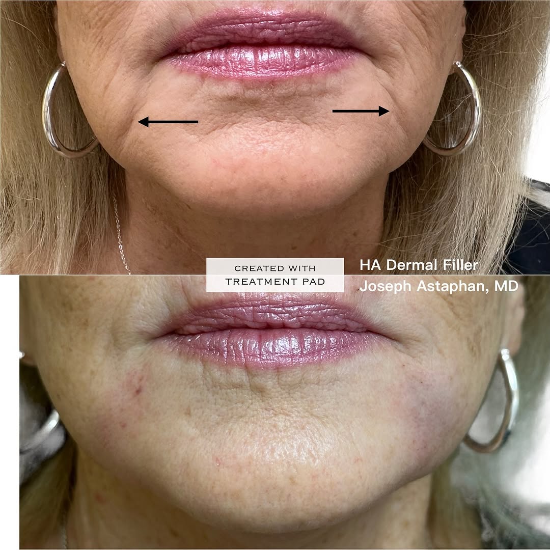 Instagram post by Dr. Joseph Astaphan: 💉Joseph Astaphan MD using his “aesthetic magic eraser™️” HA dermal filler technique” to vanish this patient’s marionette lines with HA Derm…