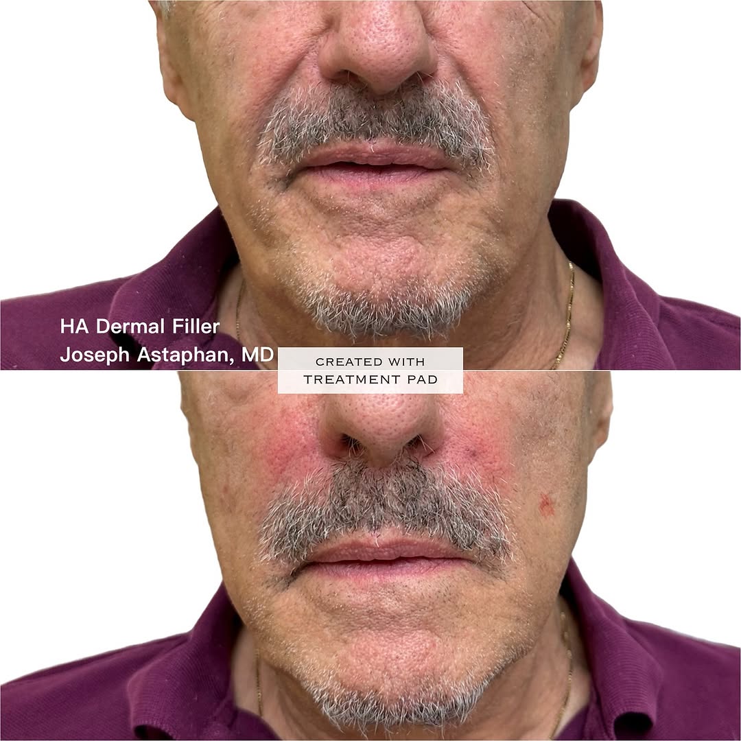 Instagram post by Dr. Joseph Astaphan: Joseph Astaphan, MD using his “aesthetic magic eraser™️ technique” to soften this patient’s nasolabial folds with HA dermal filler💉 For a f…