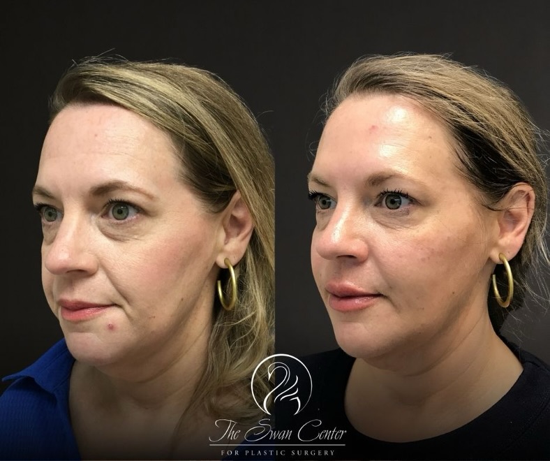 Instagram post by Dr. Joseph G. Bauer: Natural lip filler isn’t about dramatic change. It’s about shape, balance, and looking like the best version of yourself. Natural results, a…