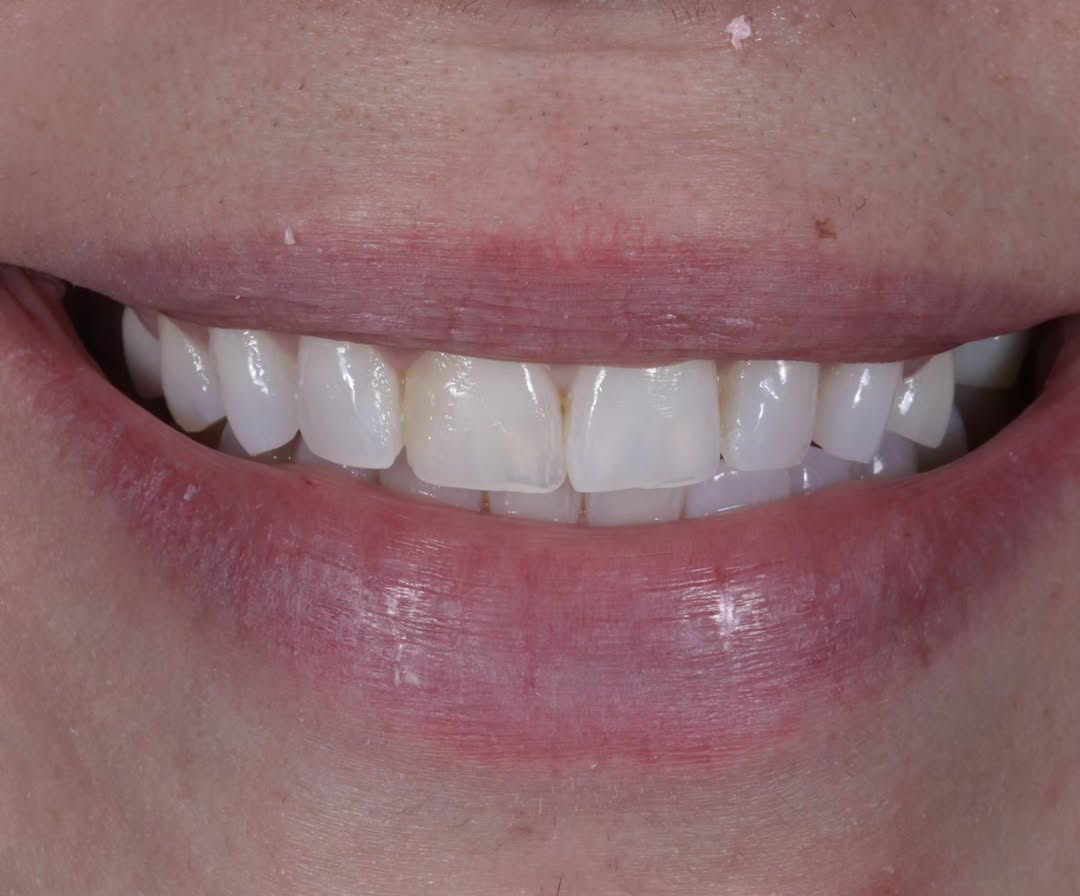 Instagram post by Dr. Joseph Goodman, DDS, D: BEFORE : How do we fix a smile like this? What is the appropriate shade, length and shape? Can we make it white yet still natural looking? M…