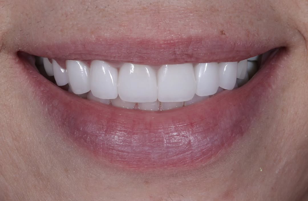 Instagram post by Dr. Joseph Goodman, DDS, D: AFTER : Porcelain veneers in OM2 shade Porcelain Veneer Transformation A beautifully balanced smile created with handcrafted porcelain venee…