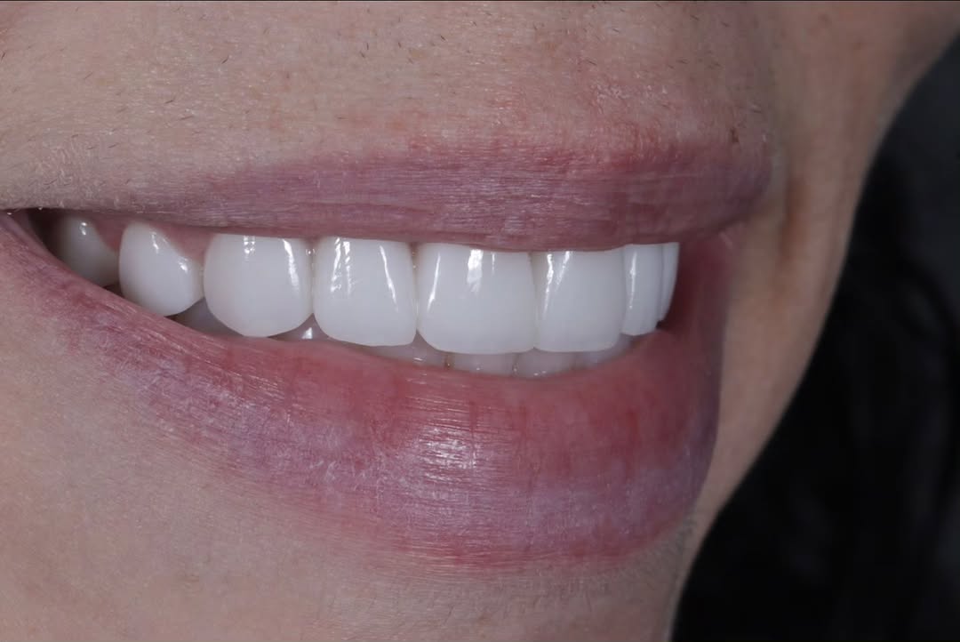 Instagram post by Dr. Joseph Goodman, DDS, D: AFTER SIDE VIEW A natural natural transformation in one week. A view from the side shows a beautiful and harmonious smile with emax veneers …