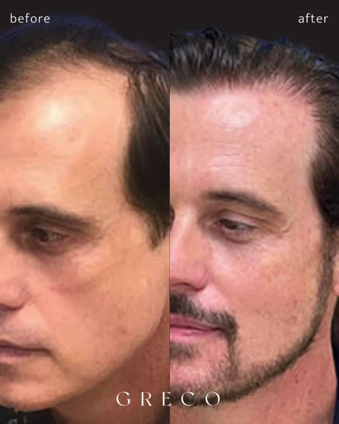 Instagram post by Dr. Joseph Greco III: Experience the pinnacle of hair restoration with our bio-enhanced FUT procedures. ✨ Bio-Enhanced Follicular Unit Transplantation (Bio-FUT…