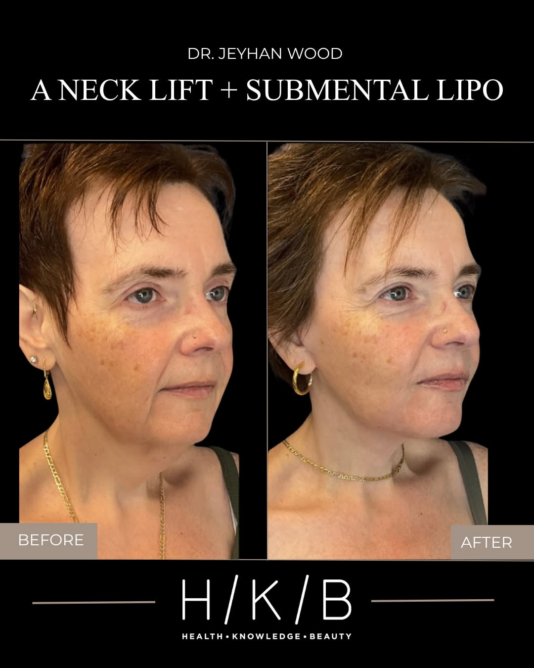 Instagram post by Dr. Joseph Hunstad: Now this is a ✨transformation✨ performed by @drjeyhanwood! What you see: A Neck Lift Submental Lipo