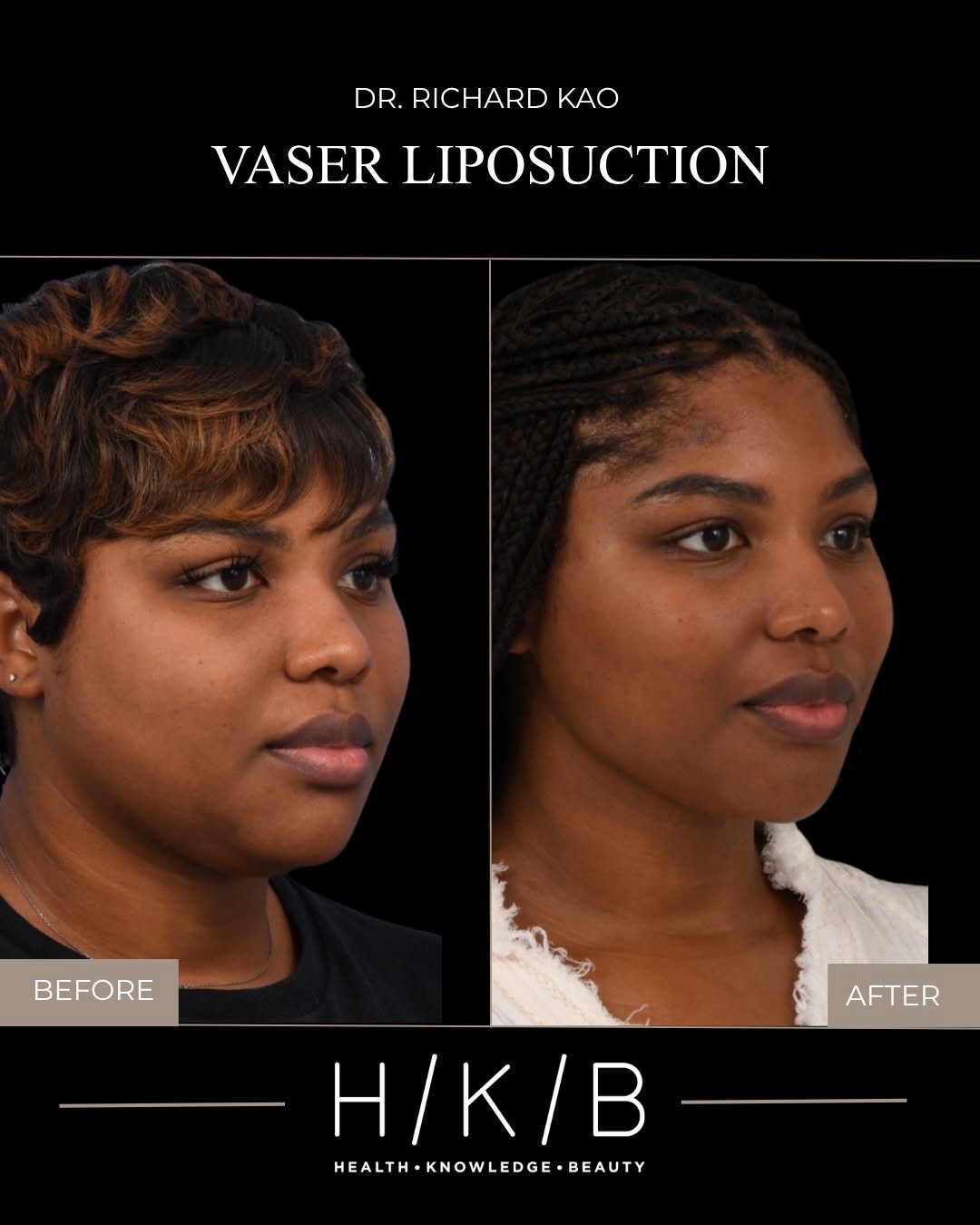 Instagram post by Dr. Joseph Hunstad: Neck liposuction using VASER by @richkaomd ✨ This patient achieved a slimmer neckline and a defined jawline while maintaining a natural look…