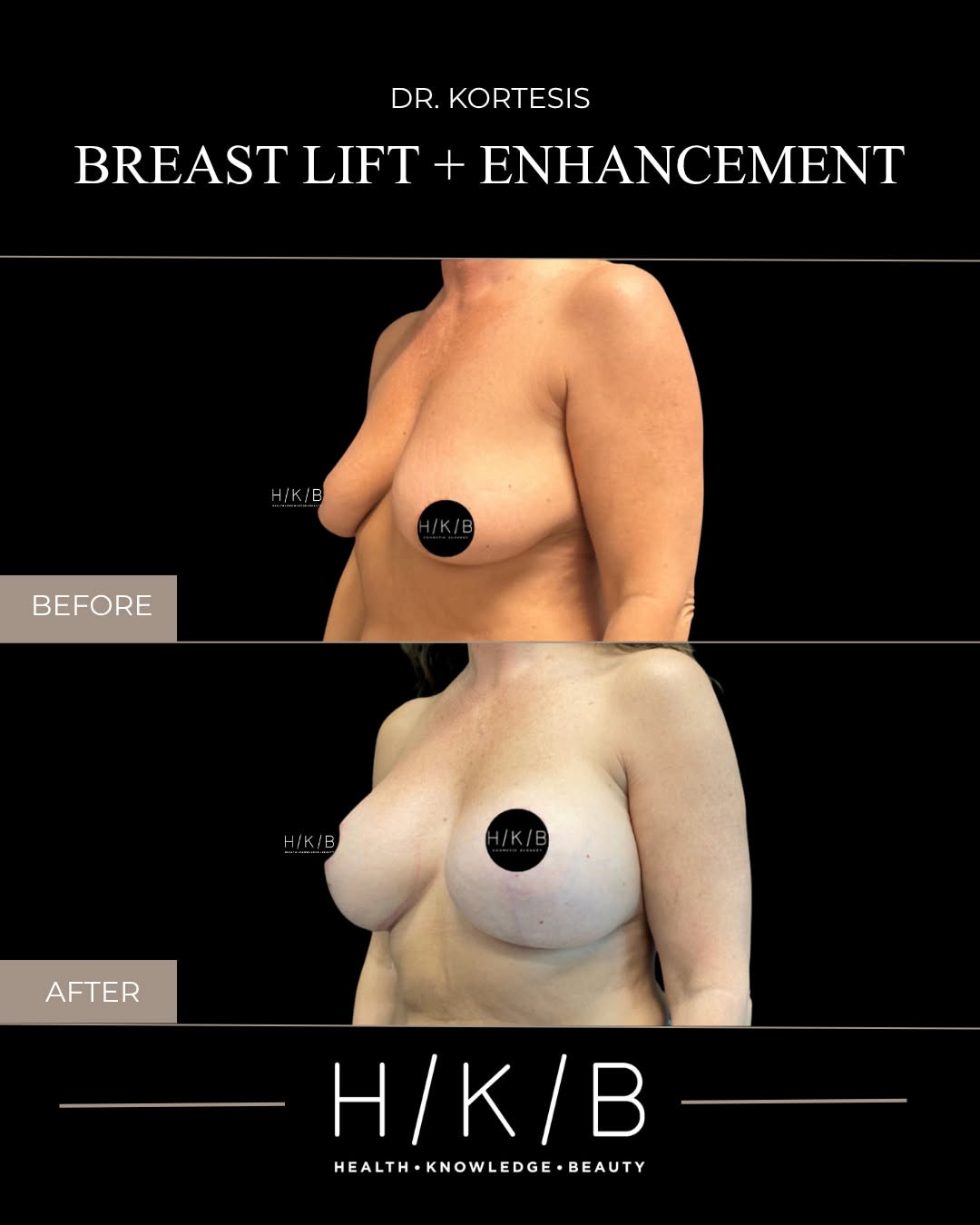 Instagram post by Dr. Joseph Hunstad: For this patient, a full mastopexy combined with a submuscular breast augmentation using 380cc implants restored fullness and resulted in na…