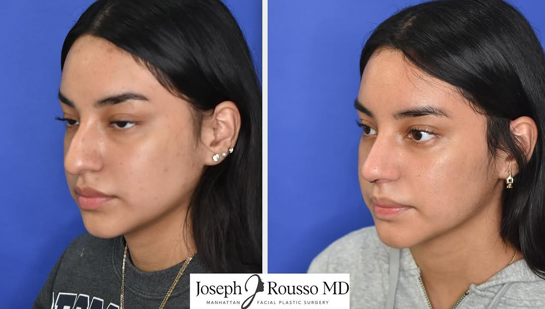Instagram post by Dr. Joseph J. Rousso: #roussorhinoplasty Another one of our wonderful patients just 1 week after #rhinoplasty . This is a young patient who wanted tip elevation, …