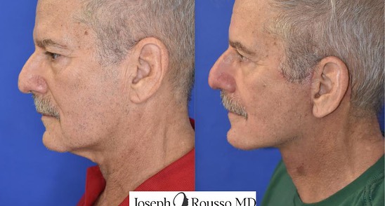 Instagram post by Dr. Joseph J. Rousso: Just 3 weeks after #deepplanefacelift performed on this wonderful gentleman for lower face and #neckrejuvenation This was done via Dr. Rouss…